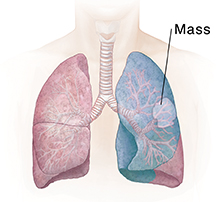 Front view of chest showing lungs. Shaded area shows lobectomy.