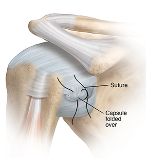 Front view of shoulder joint showing sutures being placed to repair loose capsule.