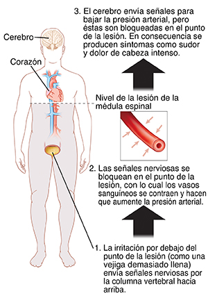 Contorno de una figura humana donde pueden verse el corazón, el cerebro y la vejiga llena. La línea horizontal justo debajo del corazón muestra el nivel de la lesión en la médula espinal. Detalle del vaso sanguíneo con flechas desde afuera que indican presión sobre el vaso sanguíneo. Un punto de irritación debajo de la lesión en la médula espinal (SCI, por sus siglas en inglés), como puede ser una vejiga llena en exceso, envía señales nerviosas a través de la médula. Las señales nerviosas se bloquean en el punto SCI, lo que hace que los vasos sanguíneos se tensen y la presión arterial aumente. El cerebro envía señales para que la presión arterial baje, pero estas señales se bloquean por la lesión en la médula espinal. Se producen síntomas como sudoración y un fuerte dolor de cabeza.