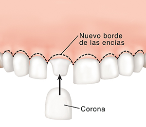 Corona colocada sobre un diente tallado. La línea punteada muestra la nueva línea de la encía.