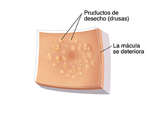 Primer plano de la retina con degeneración macular relacionada con la edad donde se observan drusas.