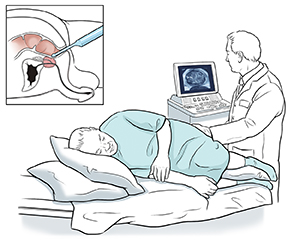 Proveedor de atención médica que realiza una ecografía transrectal en un paciente hombre.